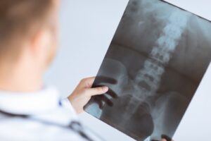 Steps to Take After a Spinal Cord Injury Accident in Port Charlotte Florida
